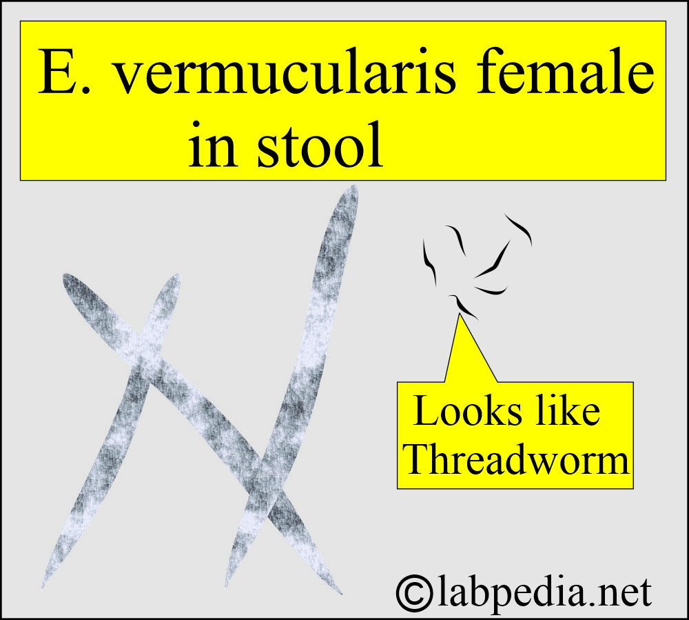 Enterobius vermicularis (Pinworm) female Enterobius vermicularis (Pinworm) female