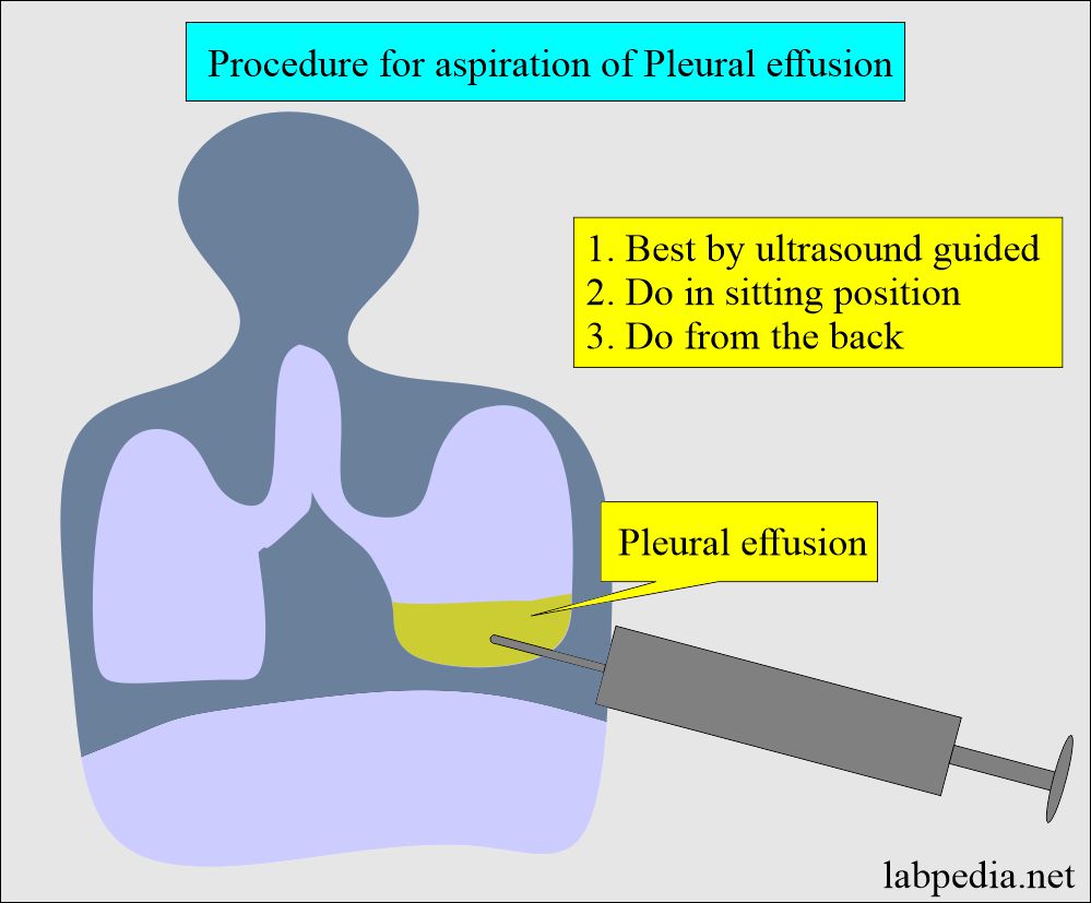 Pleural Fluid Analysis: Pleural fluid aspiration procedure (Thoracentesis)