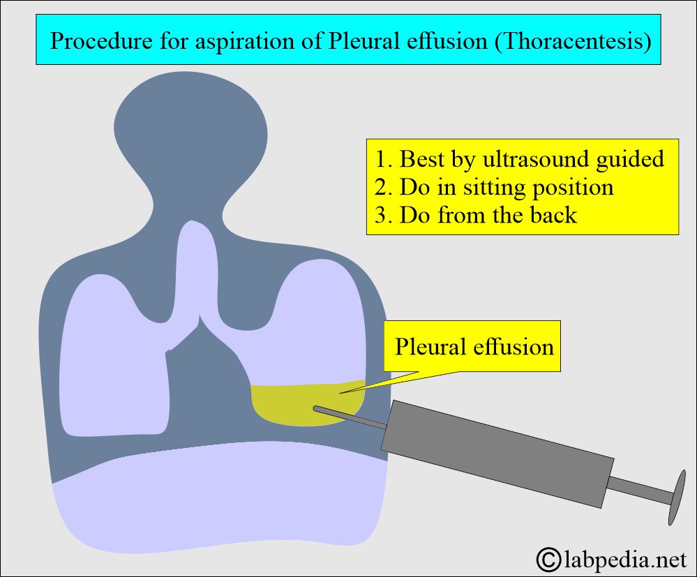 Pleural fluid aspiration (Thoracentesis)