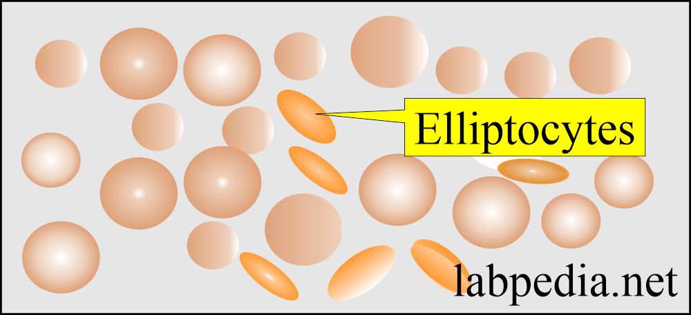 Peripheral blood smear: RBC Elliptocytes