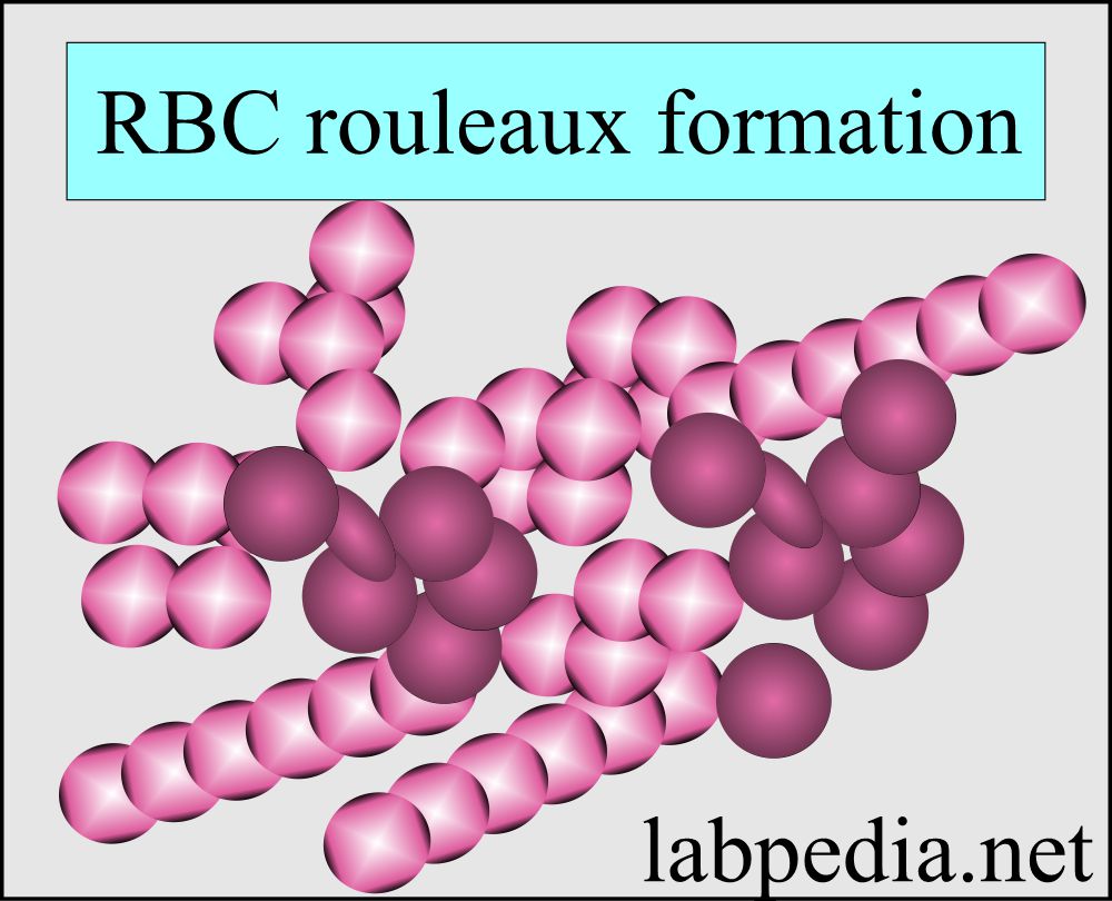 Peripheral blood smear: RBC rouleaux formation