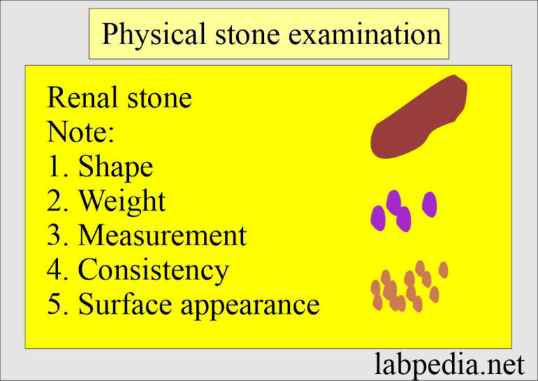 Renal Stone Analysis (Nephrolithiasis), Procedure for stone analysis ...