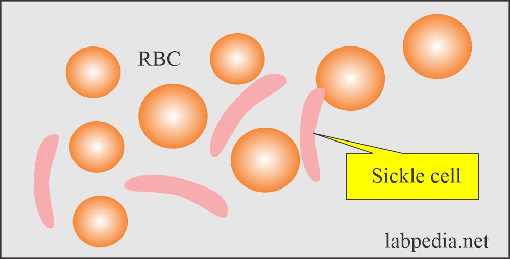 Peripheral blood smear: Sickle cell RBCs