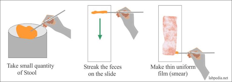 Stool Examination:- Part 1 – Normal Stool Examination (Findings