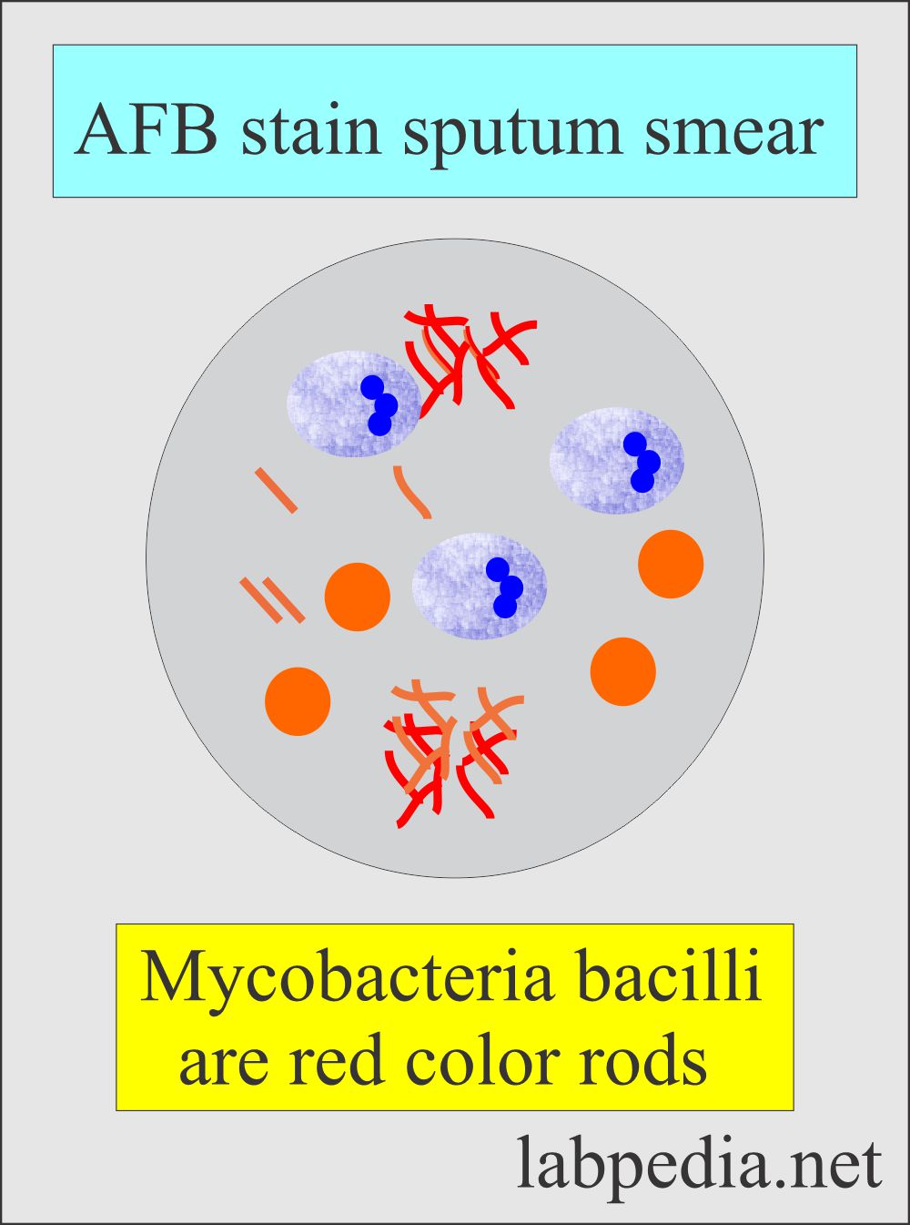 TB bacilli with AFB stain
