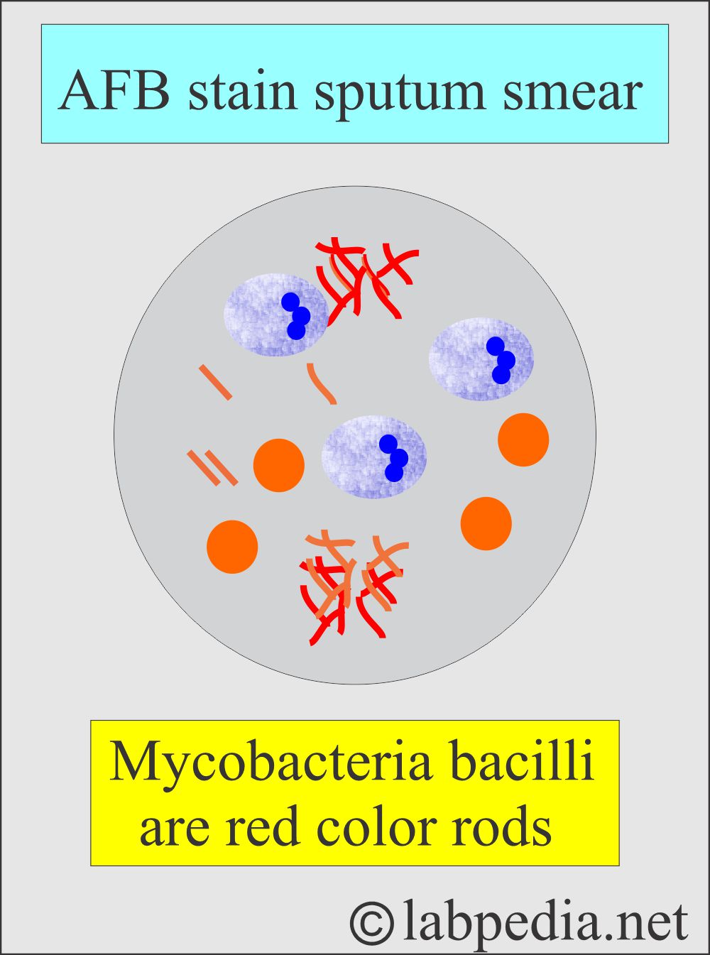 TB bacilli in sputum smear TB bacilli in sputum smear