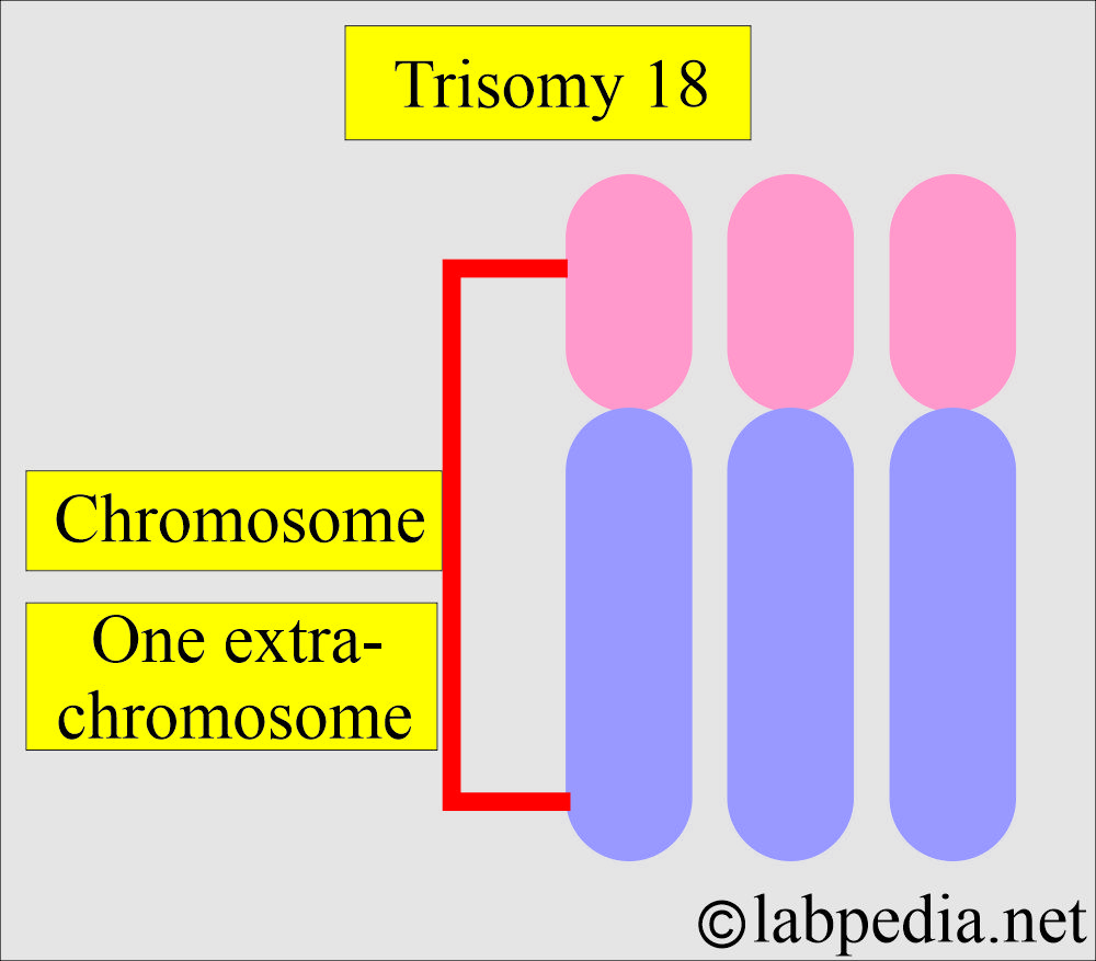 Trisomy 18 Trisomy 18