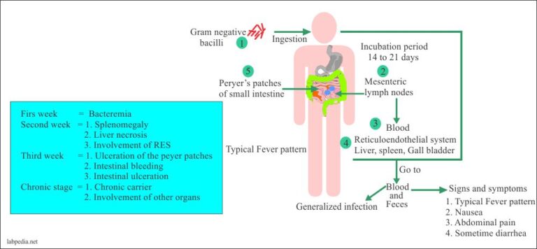 Enteric Fever – Part 1 – Typhoid Fever, Enteric Fever (Salmonella Typhi ...