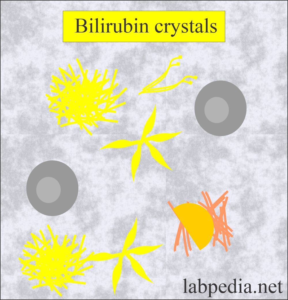 Urine Bilirubin crystals