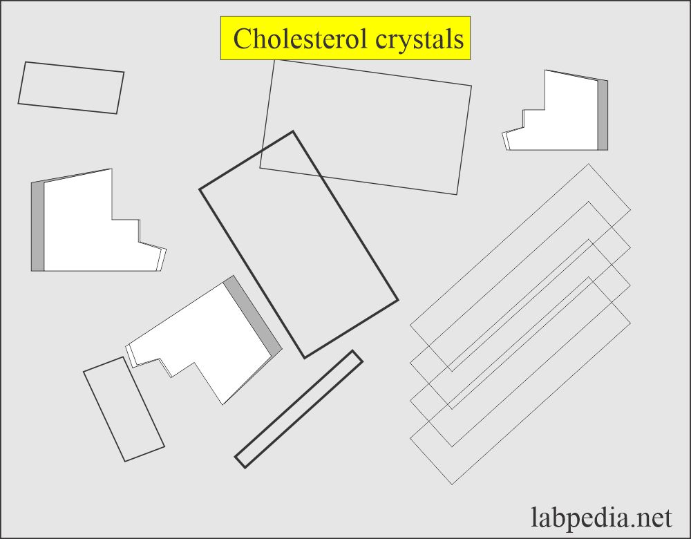 Urine Cholesterol crystals