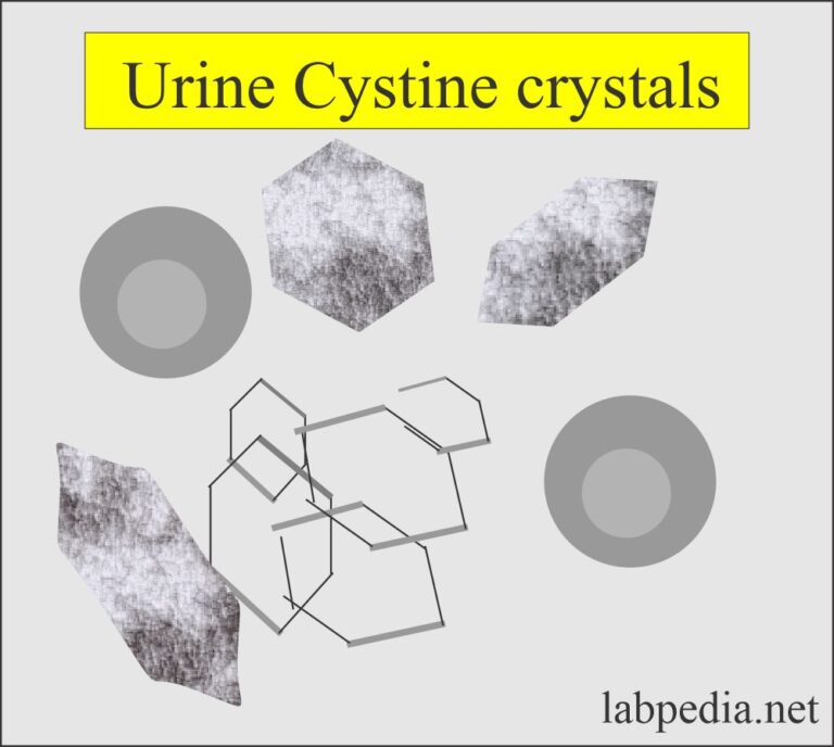 Urine Crystals (Crystalluria) - Labpedia.net