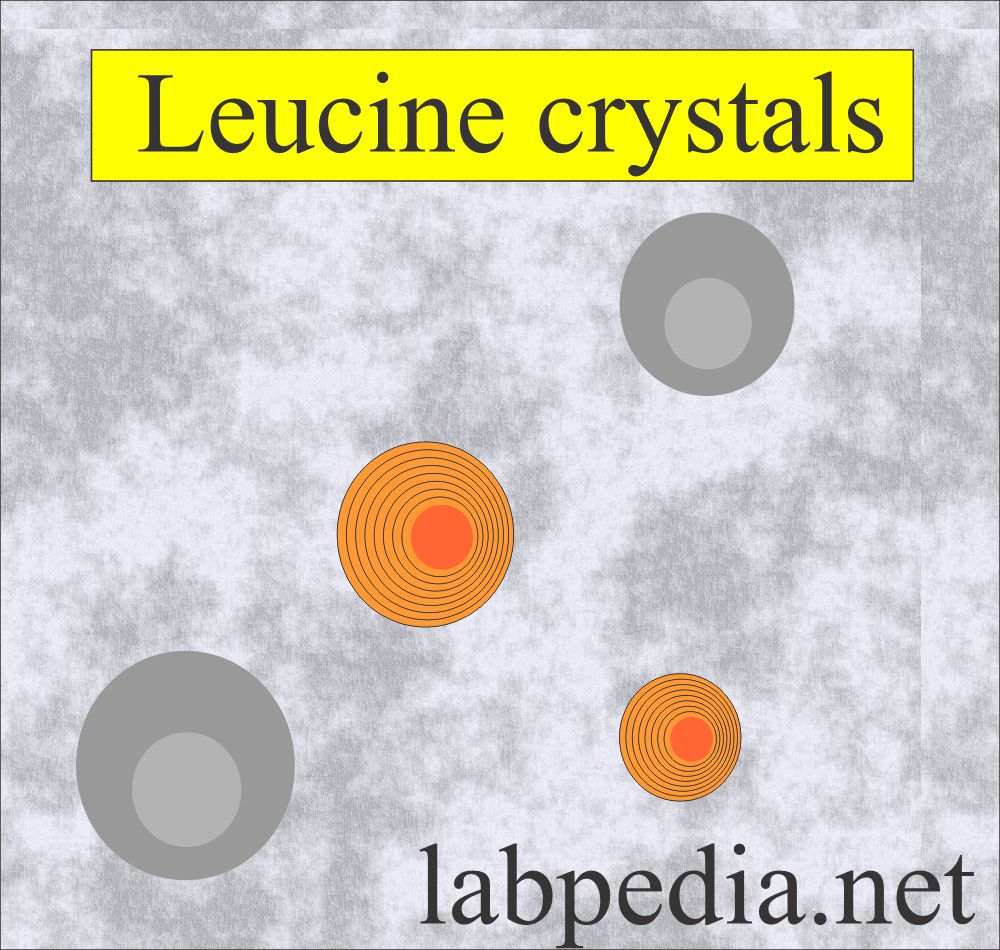 Urine Leucine crystals