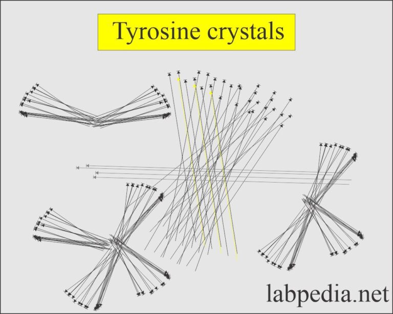 Urine Crystals (Crystalluria) - Labpedia.net