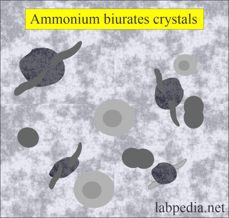 Urine Crystals (Crystalluria)