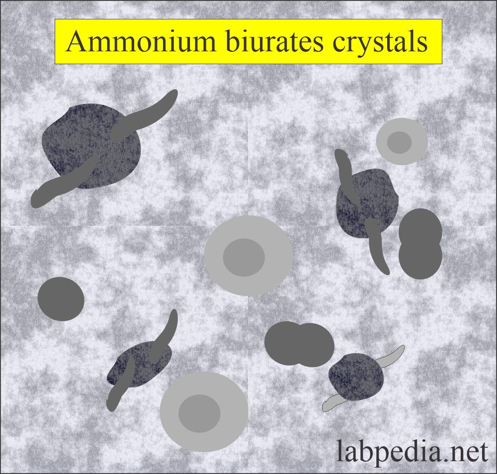 Urine ammonium biurates crystals
