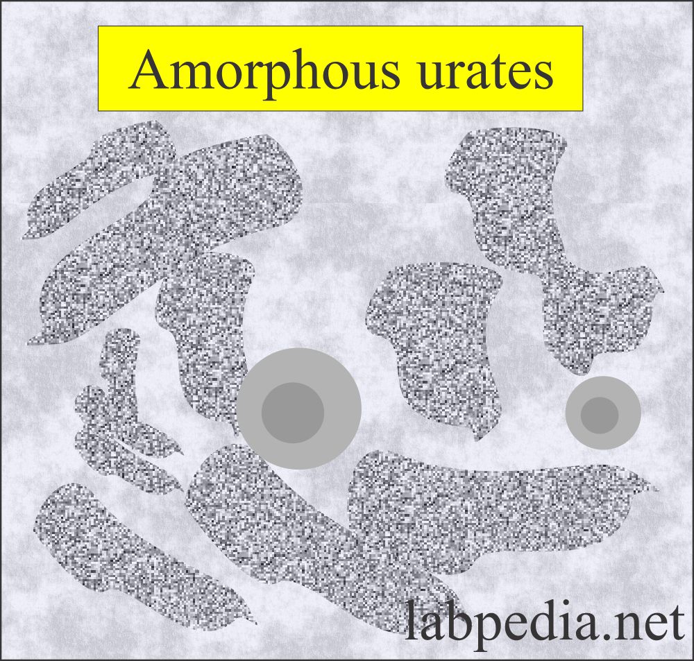 Urine Crystals (Crystalluria): Urine amorphous urates