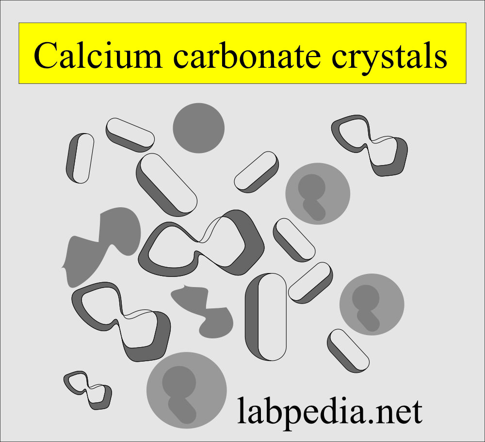 Urine calcium carbonate crystals