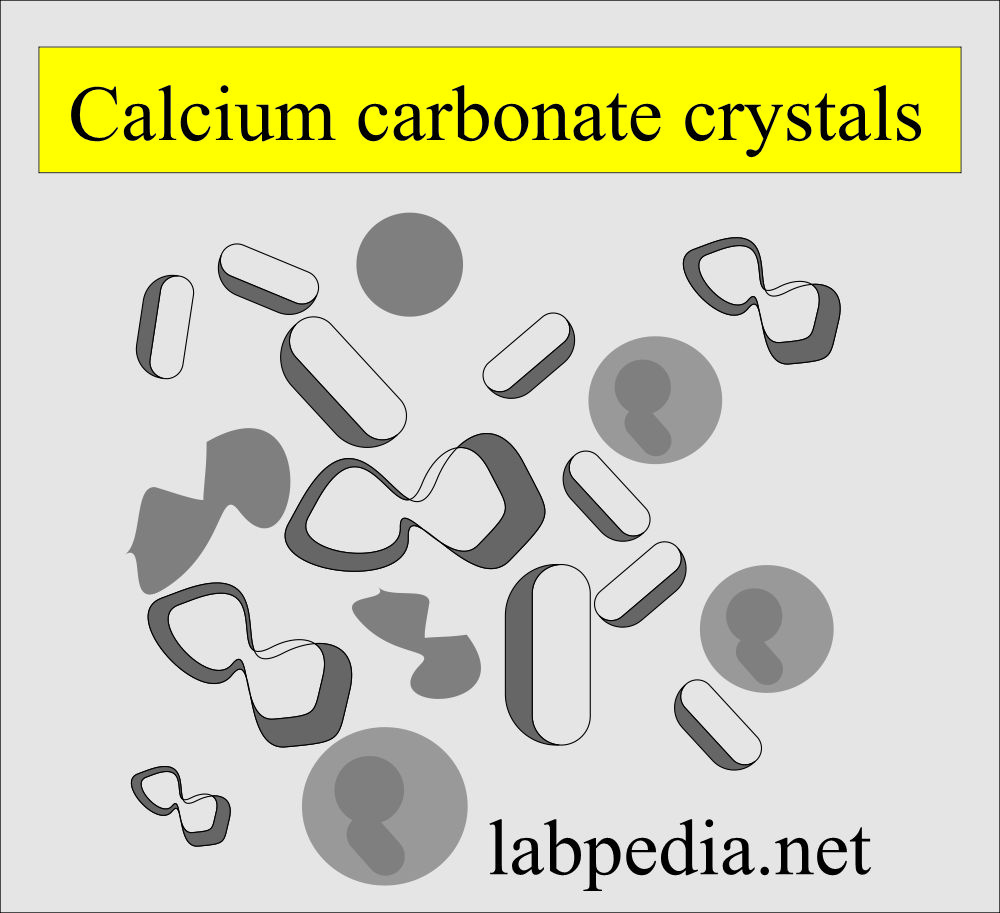 Crystals In Urine Causes At Oma Gibson Blog