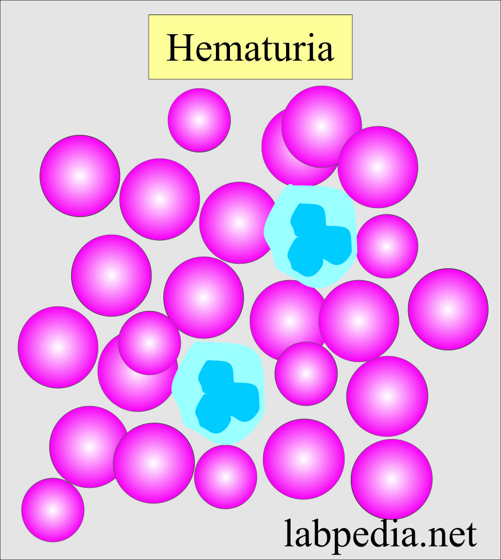 Urine RBCs (Hematuria)