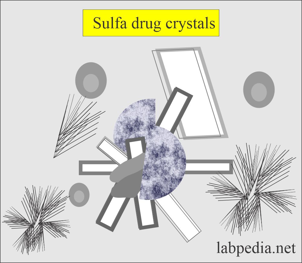 Urine sulfa drug crystals