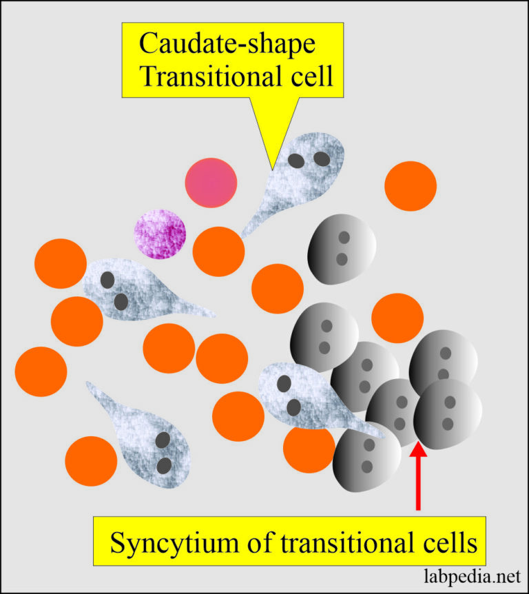 Urine Microscopic Examination, and Interpretations