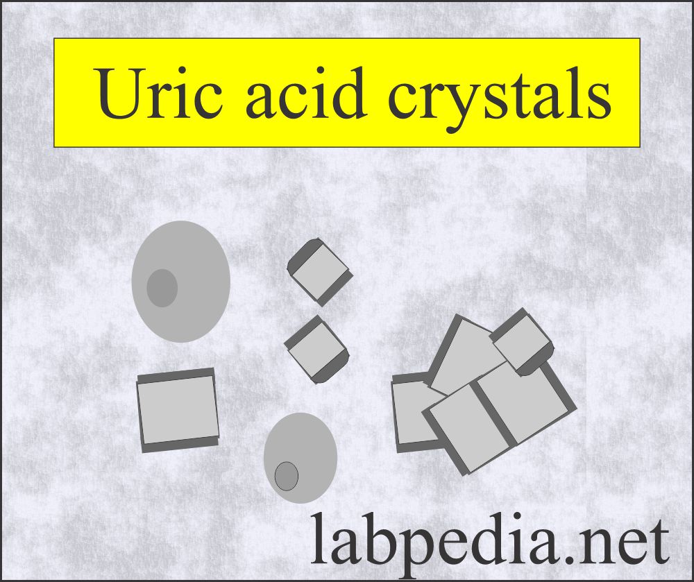 Urine Crystals (Crystalluria): Urine uric acid crystals