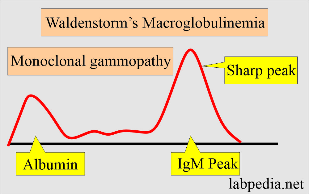 Immunoglobulin M (IgM): Waldenstorm's Macroglobulinemia
