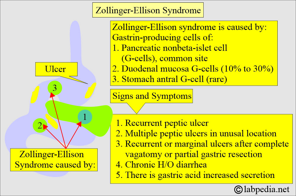Gastrin level: Zollinger-Ellison syndrome origin and signs/symptoms Gastrin level: Zollinger-Ellison syndrome origin and signs/symptoms
