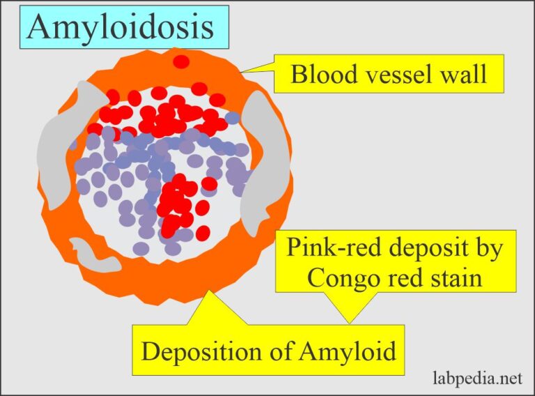 Amyloidosis, Samples, and Diagnosis