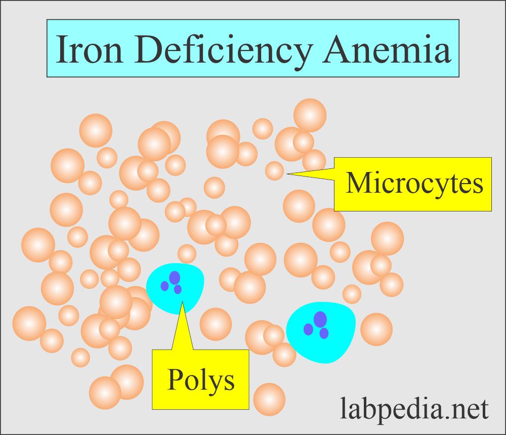 Microcytosis due to low MCHC