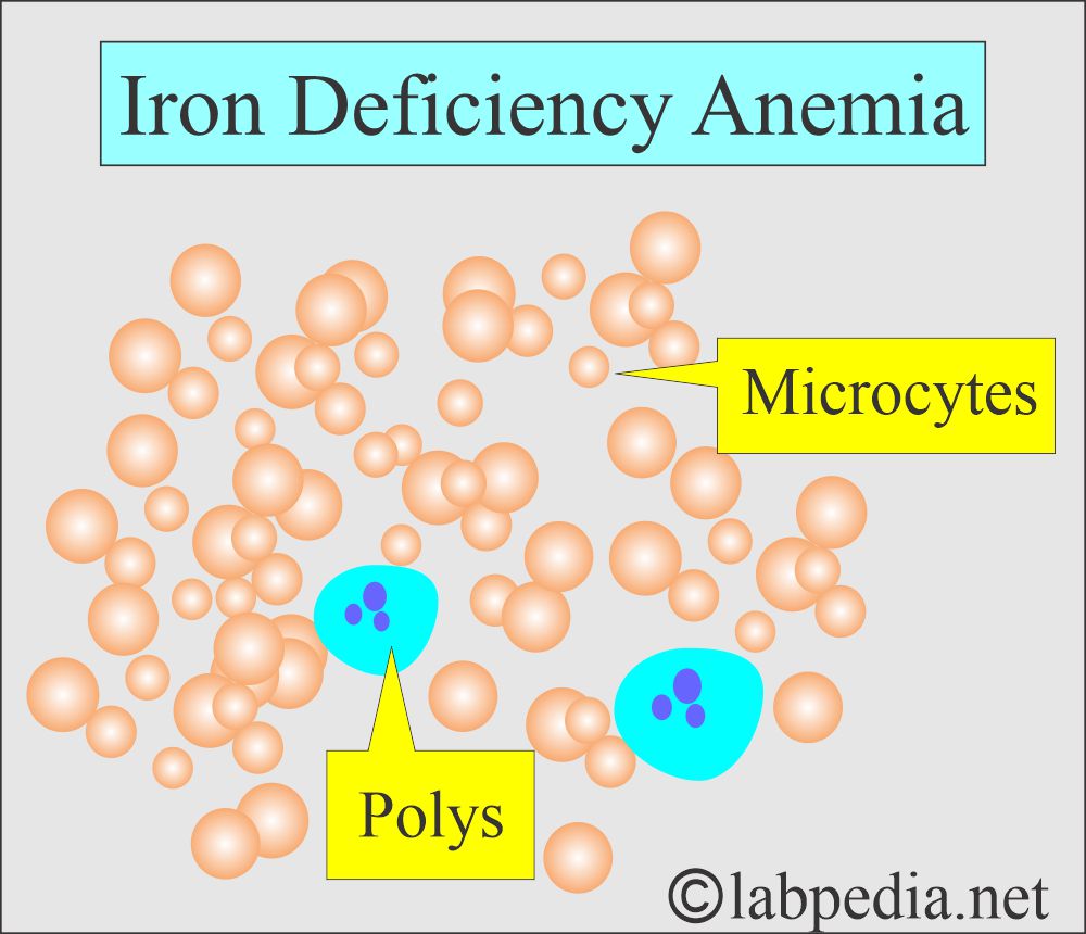 Iron deficiency anemia
