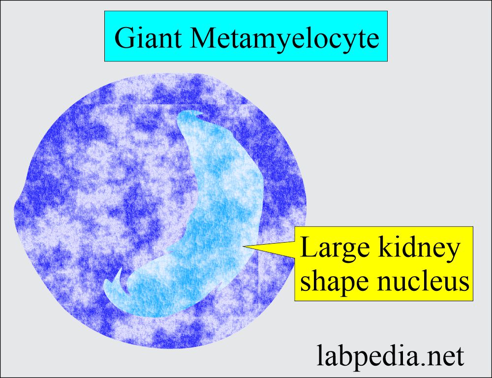 Megaloblastic anemia showing giant metamyelocyte 