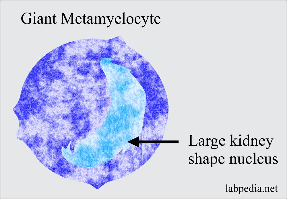Megaloblastic anemia giant metamyelocyte giant metamyelocyte