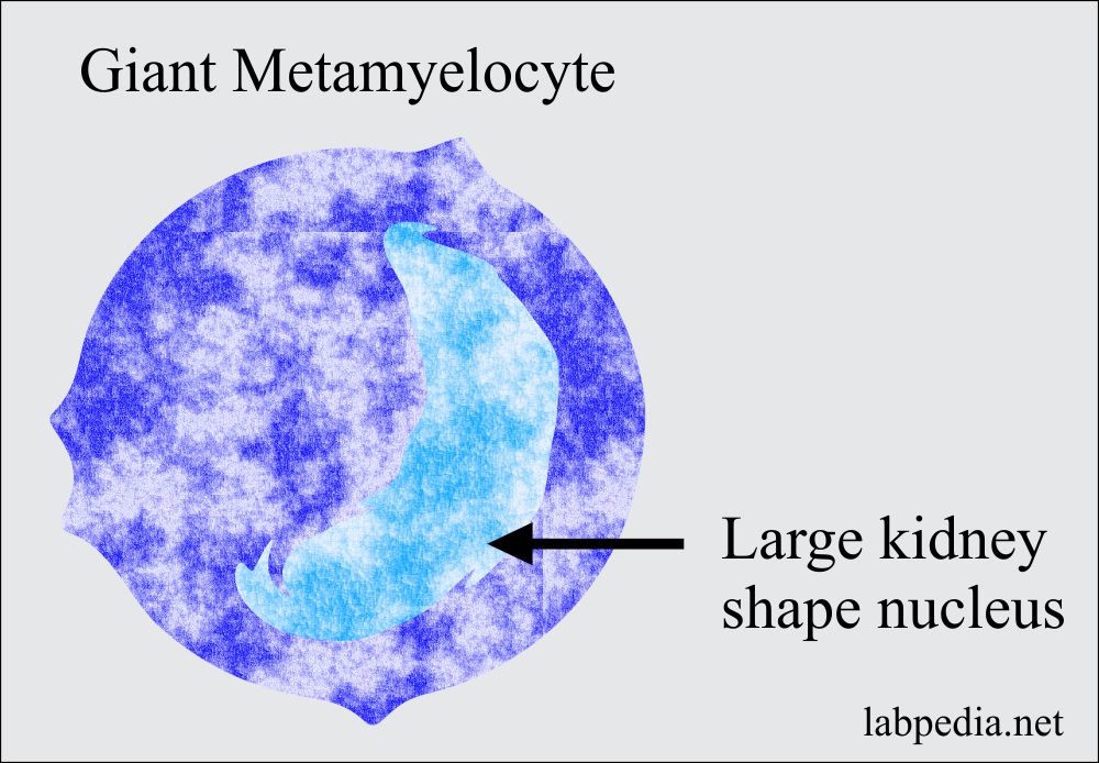 Anemia Part 3 Megaloblastic Anemias Macrocytic Vitamin B12 And 