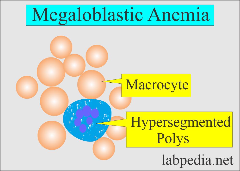 Megaloblastic anemia 