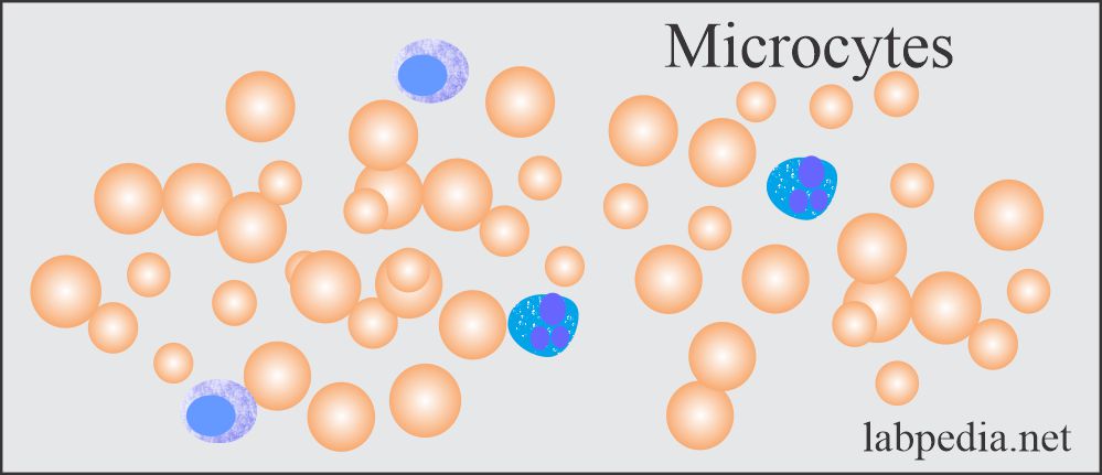 Anemia showing microcytic hypochromic RBCs