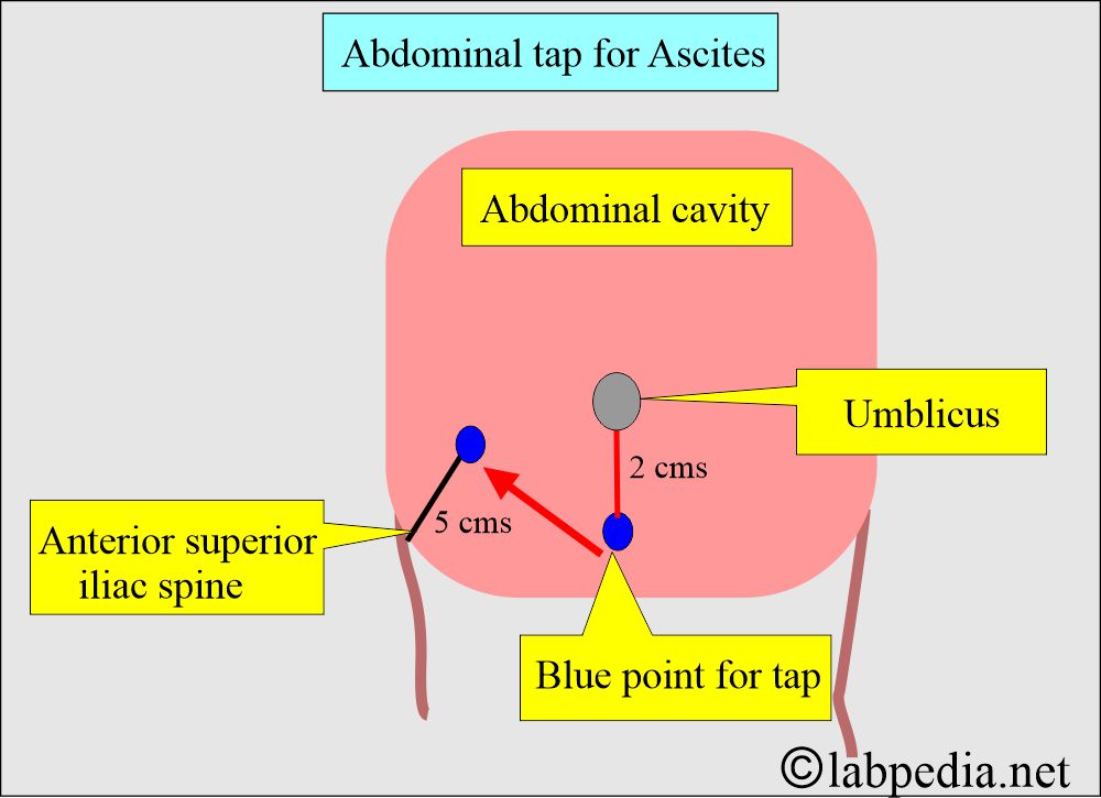 Ascites for abdominal tap Ascites for abdominal tap