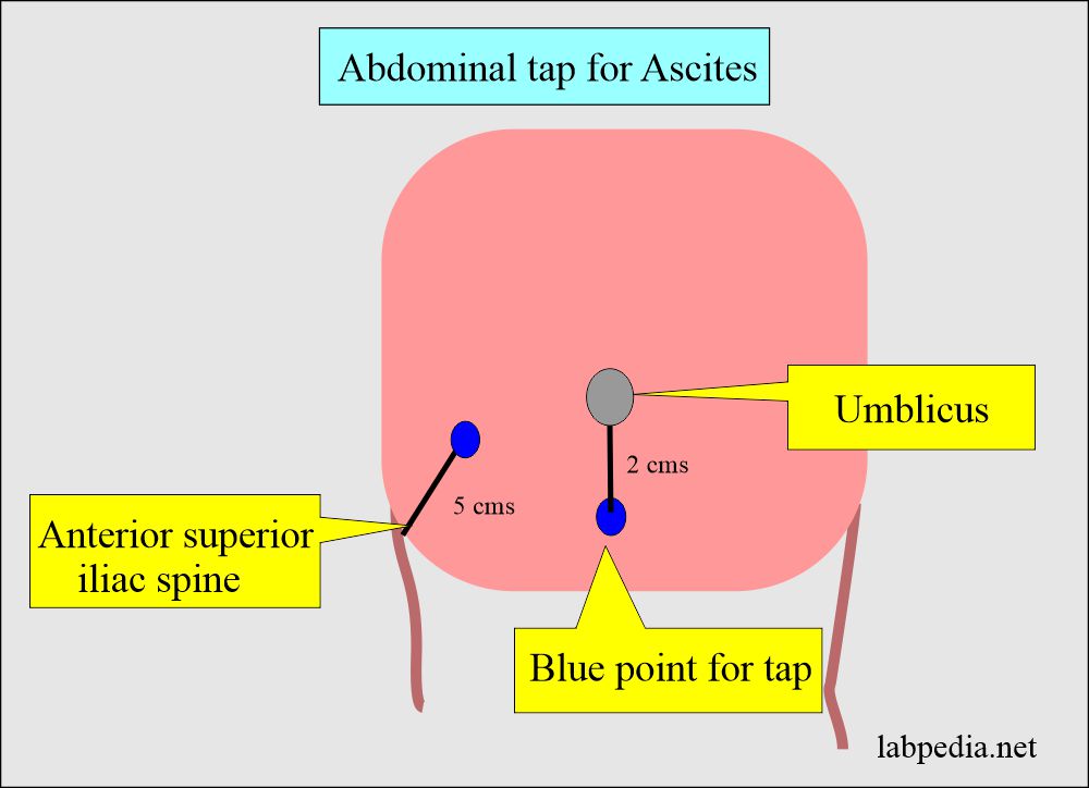 Ascitic fluid, Peritoneal tap, abdominal paracentesis: Procedure for ascites tap