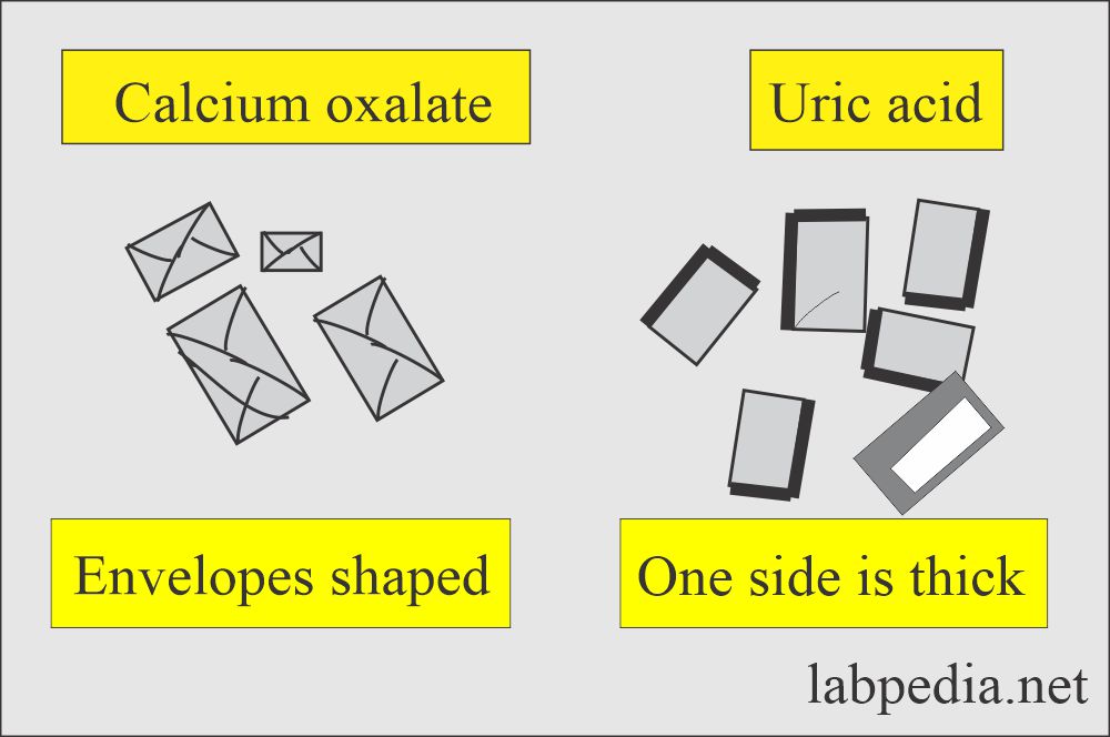 Urine Crystals (Crystalluria): Calcium oxalate and uric acid crystals