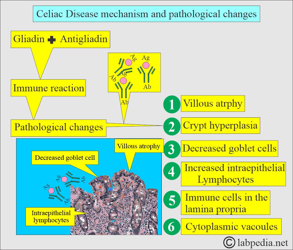 Celiac disease pathological changes