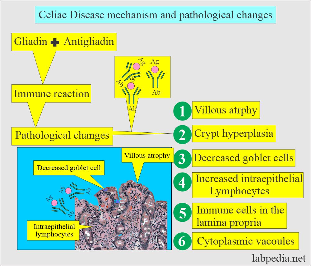 Pathological changes of Celiac disease