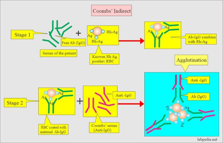 Hemolytic Anemia Of Newborn Hdn And Coombs Test