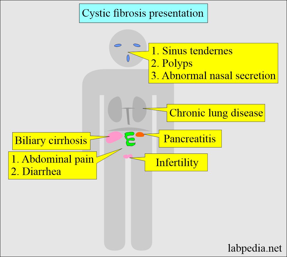 Cystic fibrosis presentation