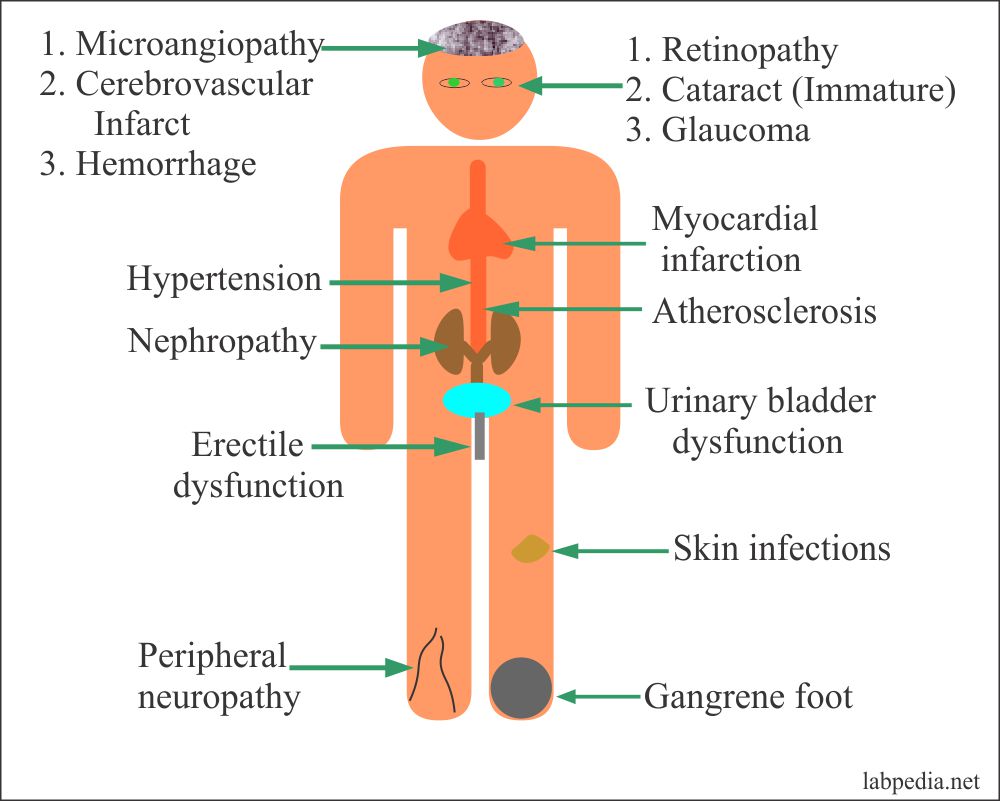 Diabetes Mellitus Definition Classification Pathogenesis Treatment And Mcqs For Neet Gpat