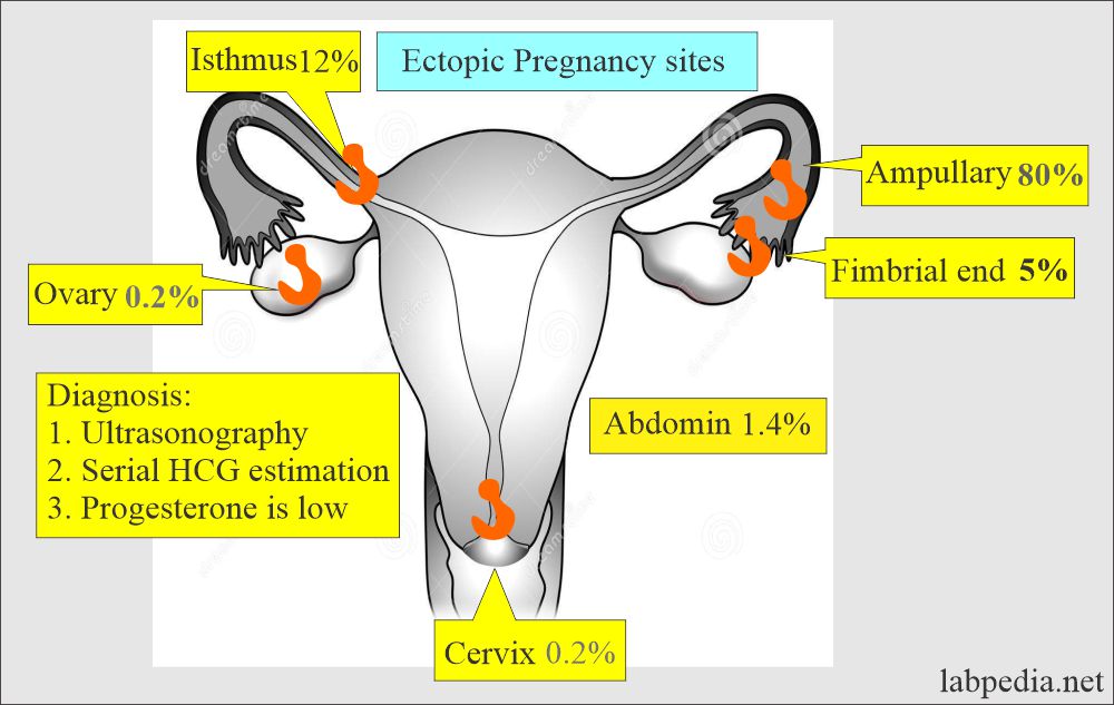 Ectopic Pregnancy and Its Diagnosis