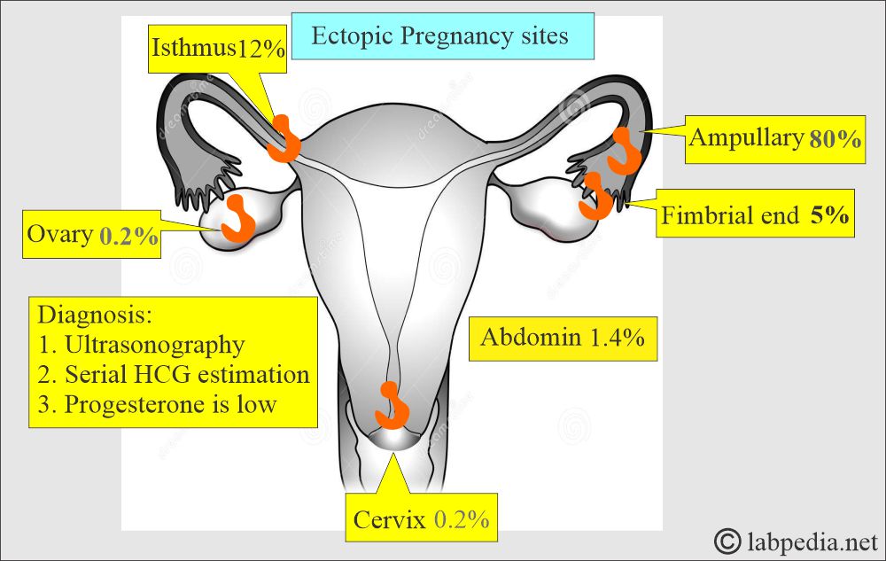 Ectopic pregnancy Ectopic pregnancy