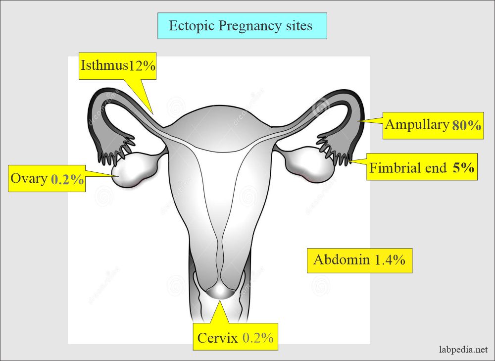 Ectopic pregnancy sites