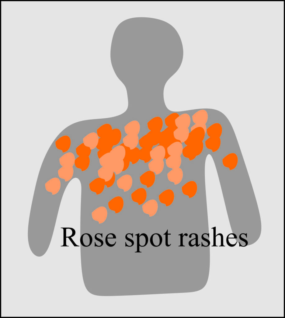 Salmonella Typhi Rose Spots