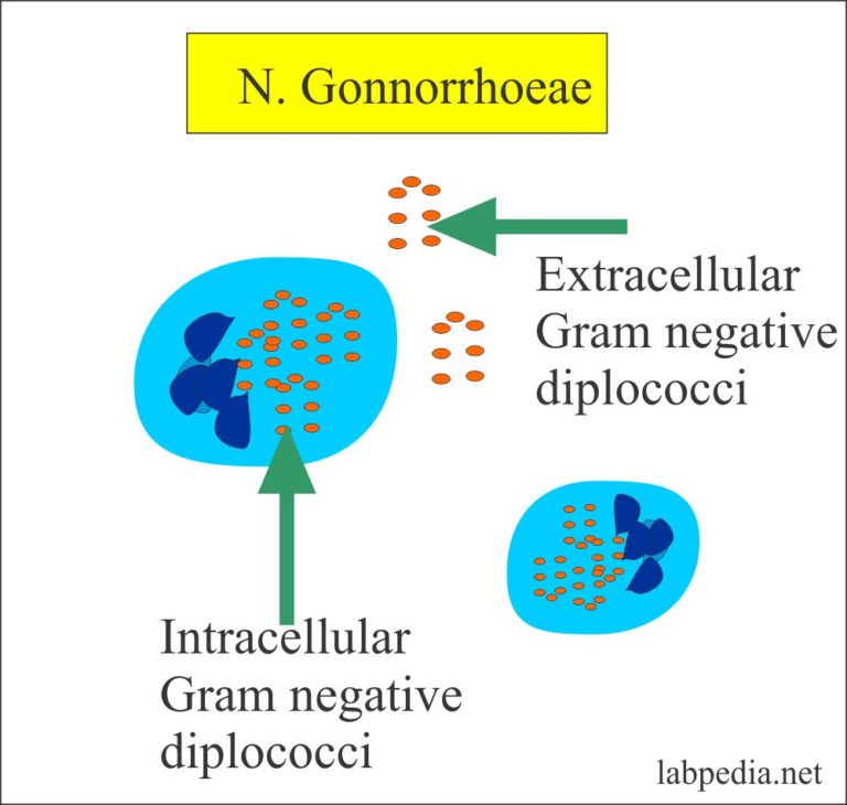 Gonorrhea Diagnosis Of Neisseria Gonorrhoeae