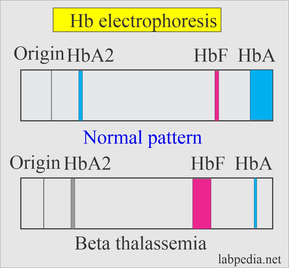 Hemoglobin electrophoresis showing Thalassemia 